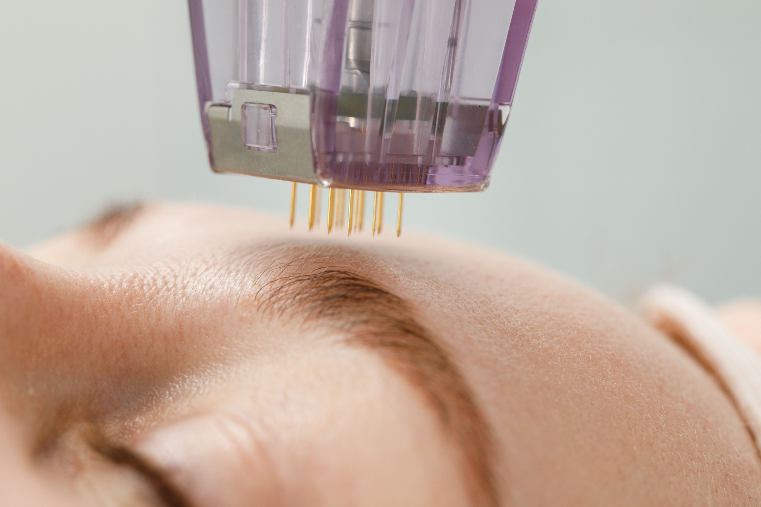 Microneedling for Skin Rejuvenation: How It Works and Why It’s Effective